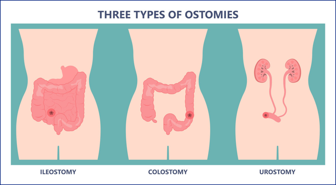 BHI Canada Ostomy Supply Discount